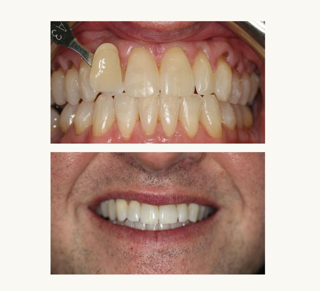 TEETH WHITENING BEFORE AND AFTER