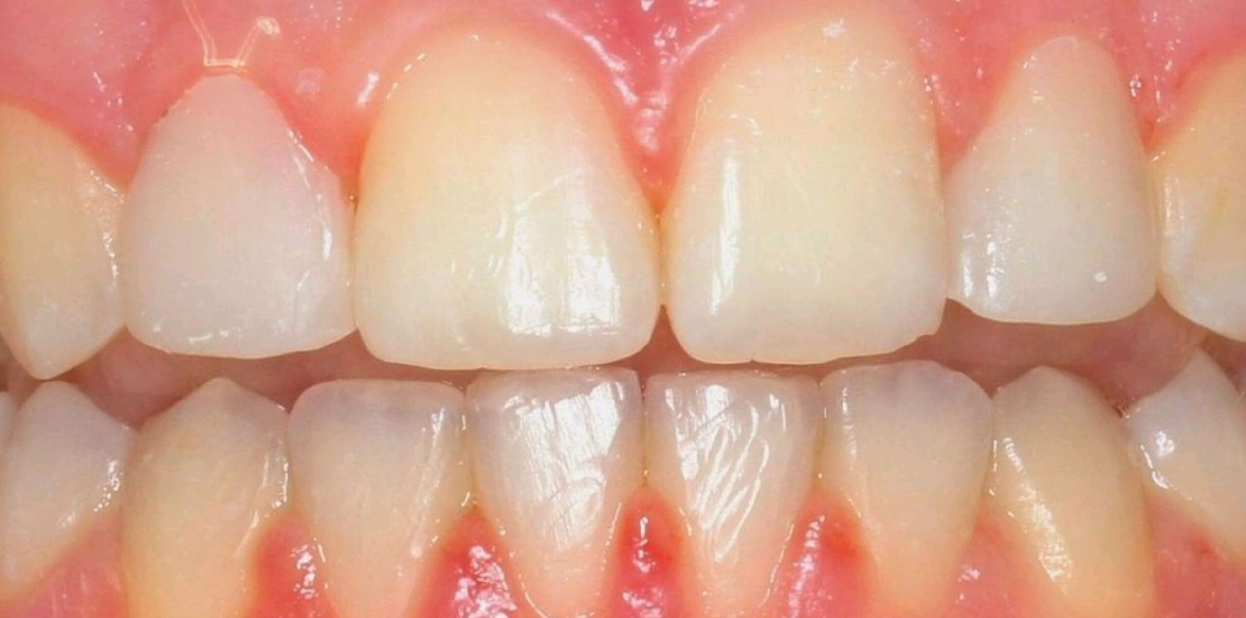 COMPOSITE BONDING AFTER