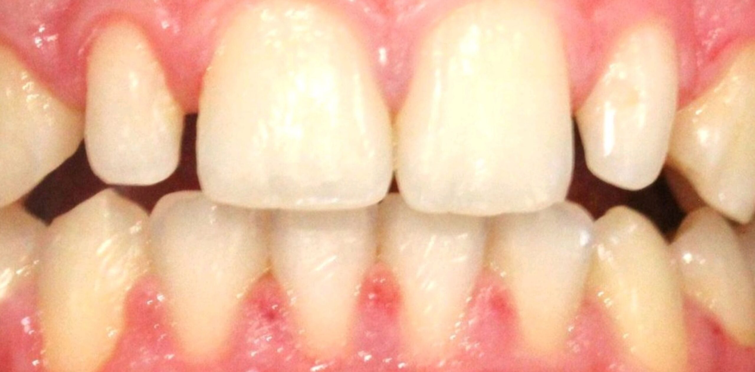 COMPOSITE BONDING BEFORE