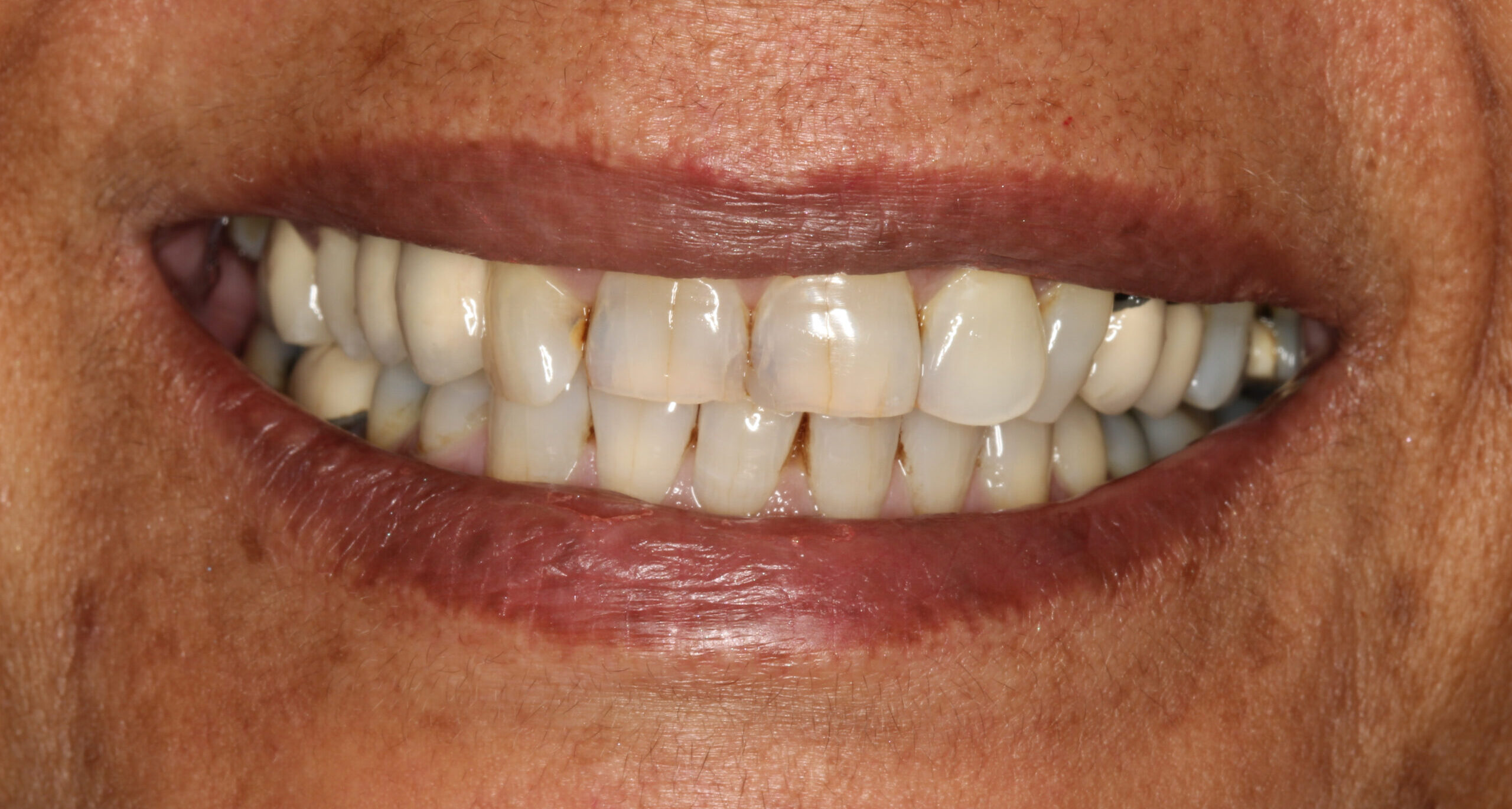 FRONTAL SMILE AFTER