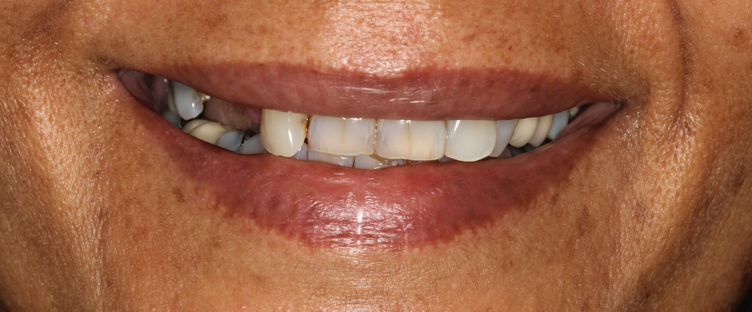 FRONTAL SMILE