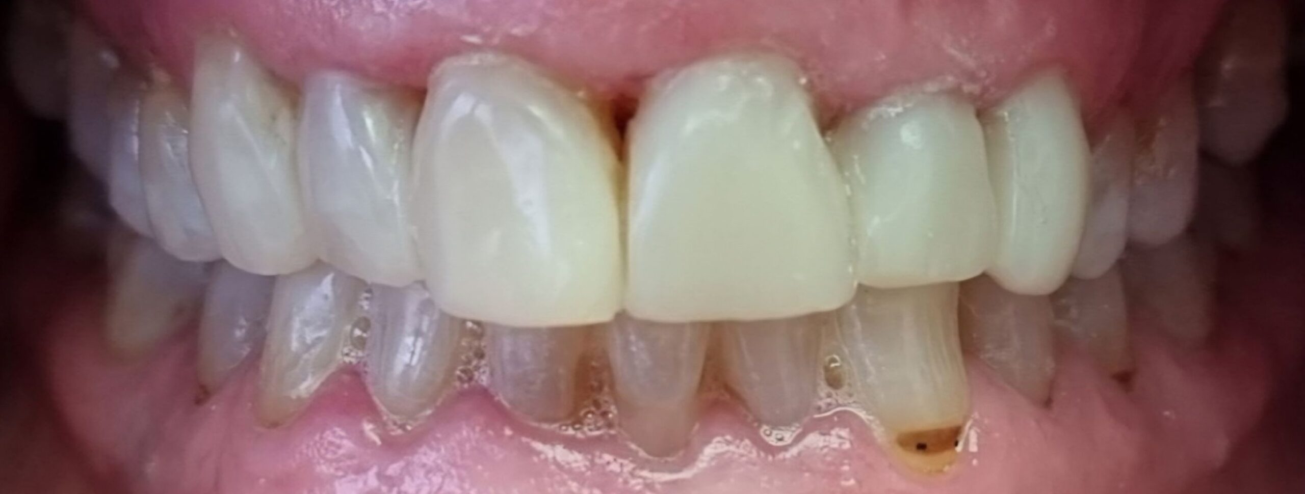 G. COOPER UPPER AND LOWER RETRACTED AFTER
