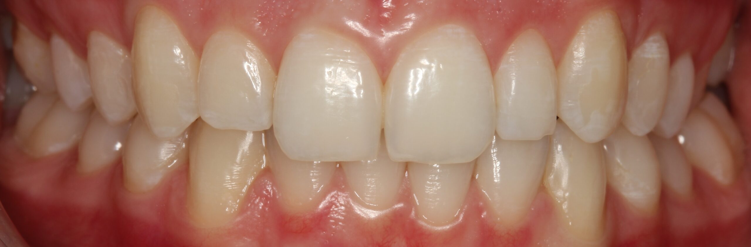K DYKES UPPER AND LOWER RETRACTED AFTER