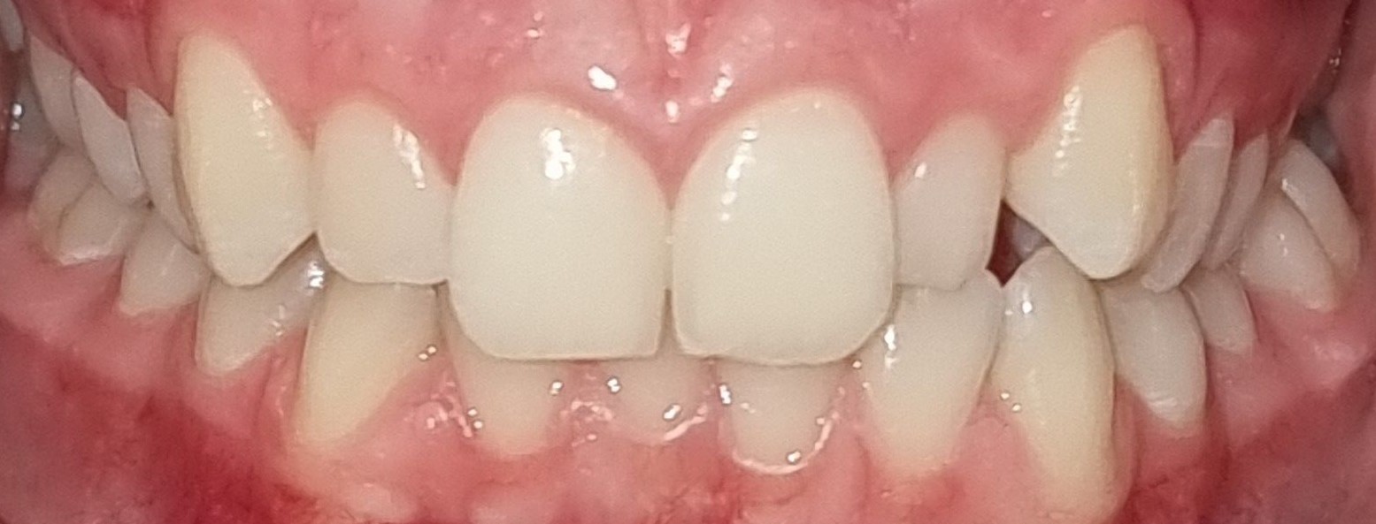 K DYKES UPPER AND LOWER RETRACTED BEFORE