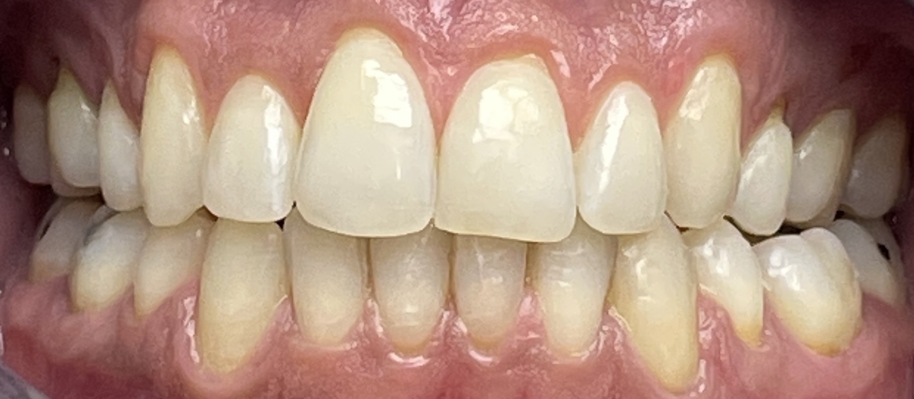 P. REHAL UPPER AND LOWER RETRACTED AFTER