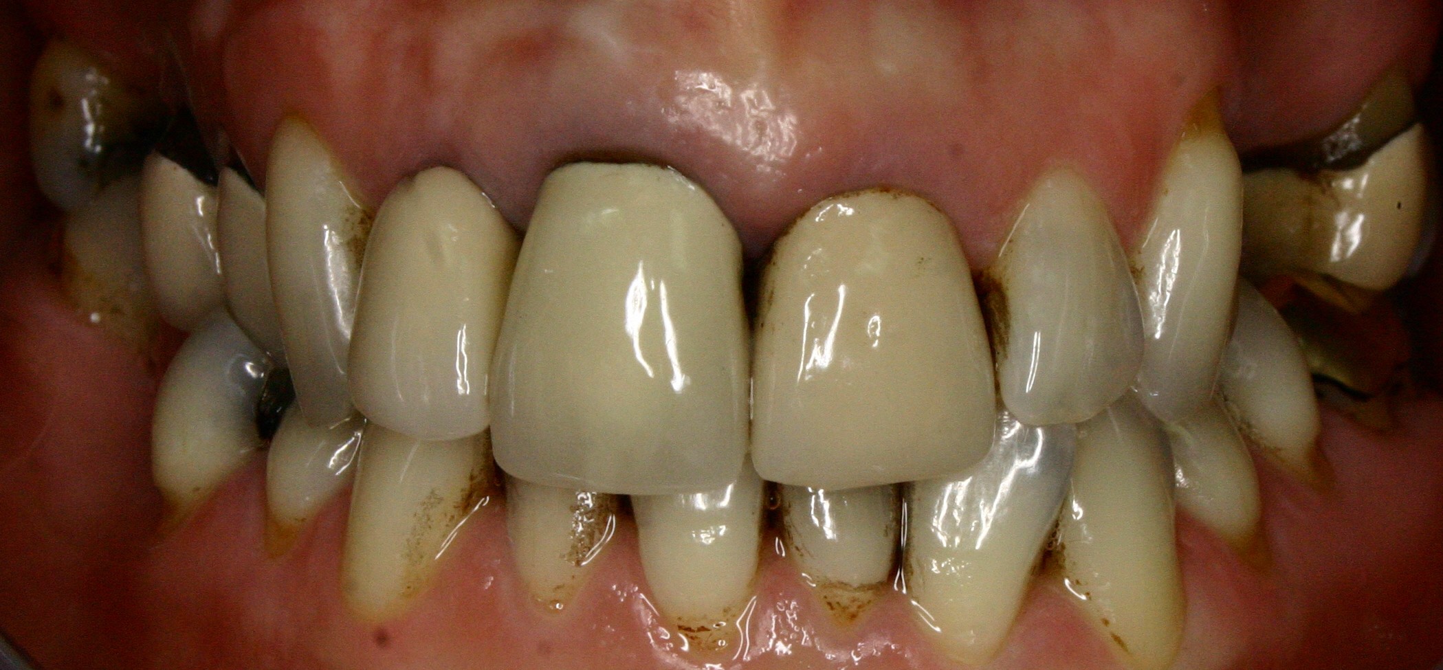 T STACY BEFORE RETRACTED FRONTAL SMILE