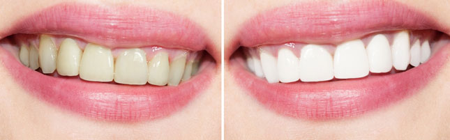 Egham-Dental-Care---Tooth-Whitening-Before-After